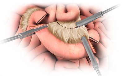 Bowel Resection