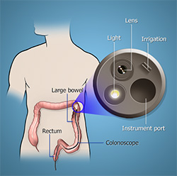 Flexible Sigmoidoscopy