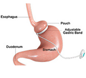 Gastric Band