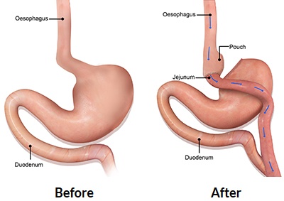 Gastric Bypass