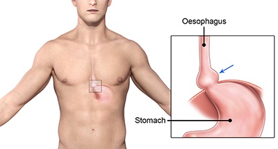 Hiatus Hernia