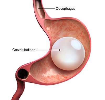 Intragastric Balloon