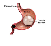 Intragastric Balloon