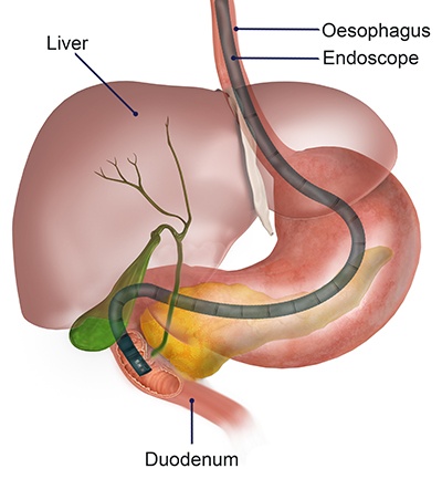 Oesophago Gastro Duodenoscopy