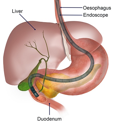 Gastroscopy Melbourne Coeliac Disease Melbourne Liver Cirrhosis Gastroscopy Melbourne Coeliac Disease Melbourne Liver Cirrhosis