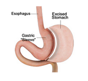 Gastric Sleeve