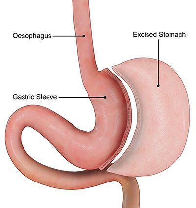 Sleeve Gastrectomy