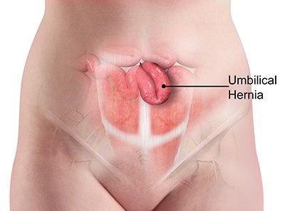 Diagnosis & Treatment of Umbilical Hernia